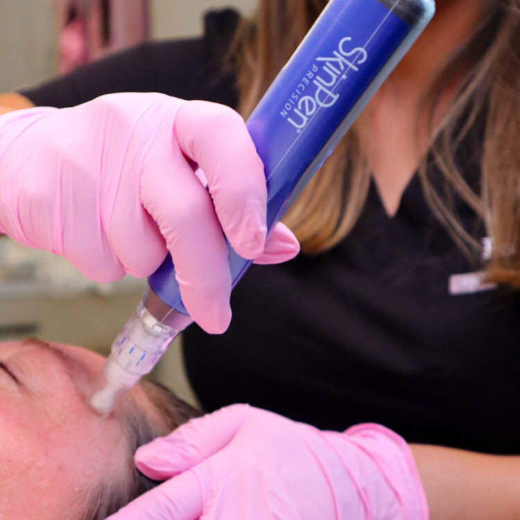 Microneedling