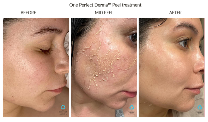 Chemical Peels