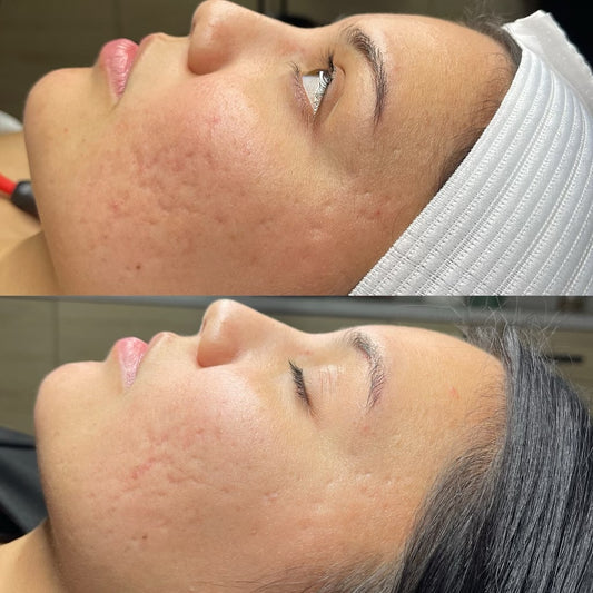 Perfect Derma Peel